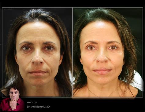 PlasmaSculpt-Sculptra-PRF-Collagen-Fillers-Natural-Before-After-125 ...