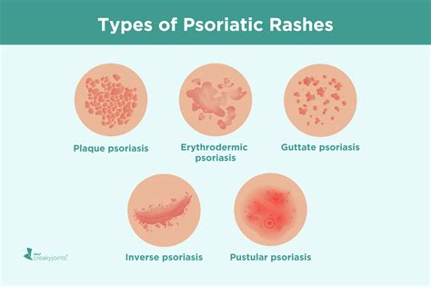 Psoriatic Arthritis Rash: Symptoms, Treatment, and Pictures