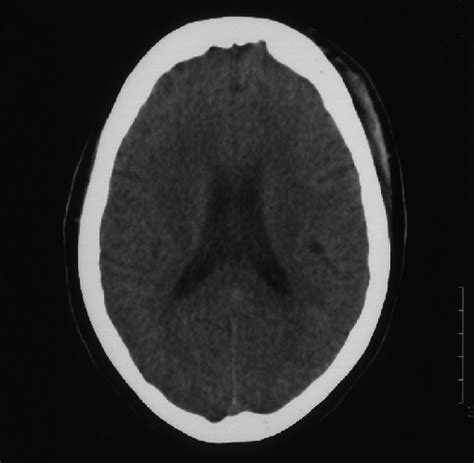 Initial CT scan of the brain. | Download Scientific Diagram