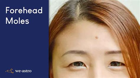 Mole on forehead | Know what your mole tells about you