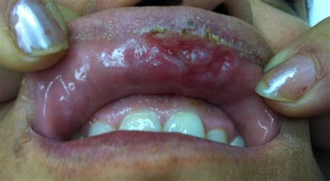 Labial ulcer: oral manifestation of syphilis | The Brazilian Journal of ...