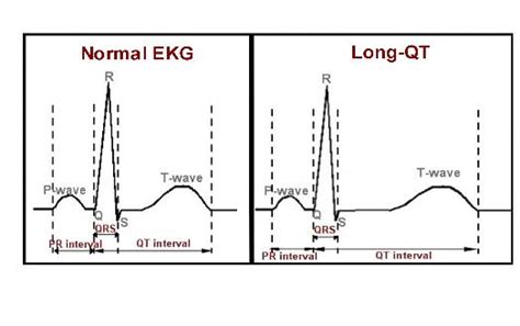 Treatment for Long QT Syndrome (LQTS) in Washington DC & Maryland