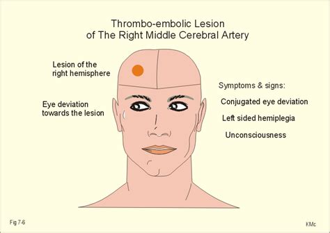 Middle cerebral artery occlusion - The USMLE Network