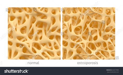 Bone Spongy Structure Closeups Normal Osteoporosis Stock Illustration ...