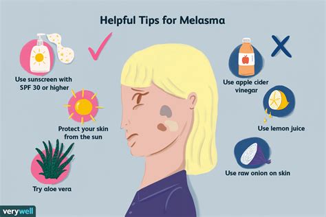 Melasma Treatment: Home Remedies, Prescriptions, & Procedures