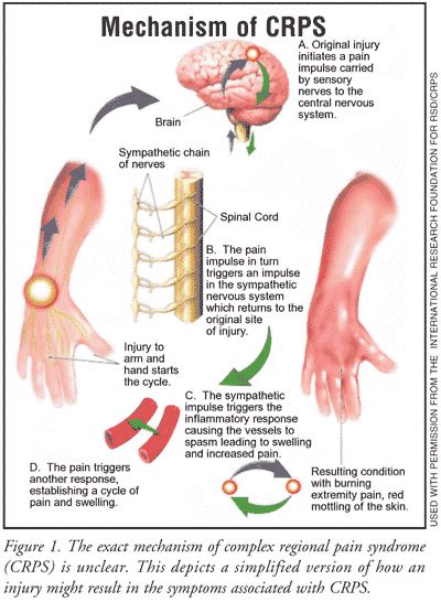 CRPS Guest Blog: Complex Regional Pain Syndrome - Capital Area PT ...