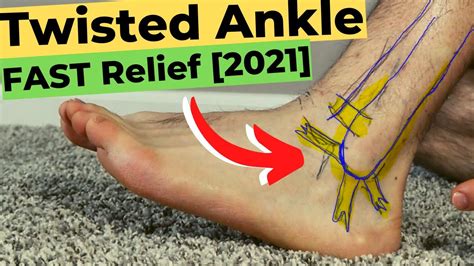 High Ankle Sprain Recovery Time: *The Best Treatment Guide!*