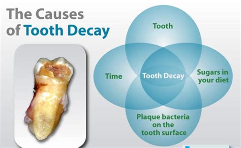 tooth-decay-causes - ABC Dental