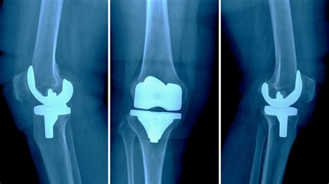 Knee Joint Replacement Devices