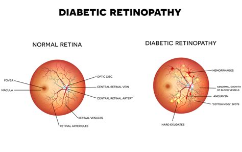 Diabetic Retinopathy Causes and Diagnosis | FLEI