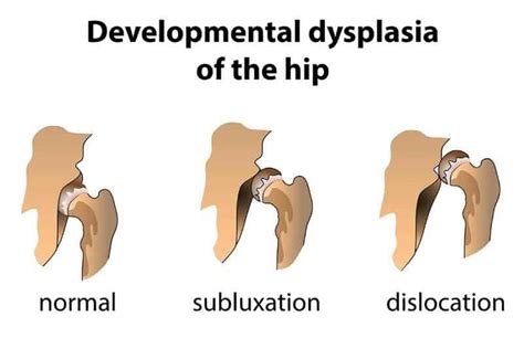 Canine Hip Dysplasia – Facts and Symptoms – German Shepherd Country