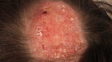 Lupus Hair Loss: Pictures, Symptoms, Treatment, Prevention, and More