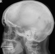 Skull - Radiology Study Aids