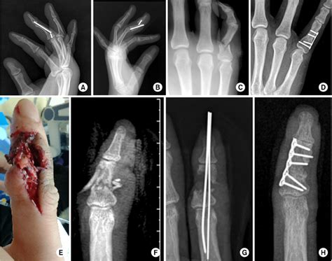 Proximal Phalanx Fracture Splint