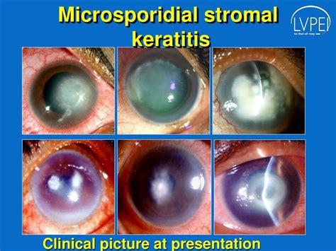 PPT - Microsporidial Stromal Keratitis : Dilemma in Clinical Diagnosis ...