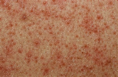 Keratosis Pilaris - Causes, Symptoms, How To Get Rid of It