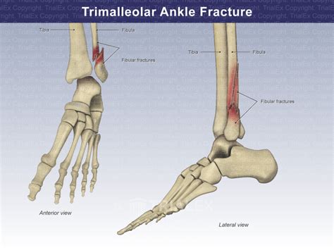 Trimalleolar Ankle Fracture - Trial Exhibits Inc.