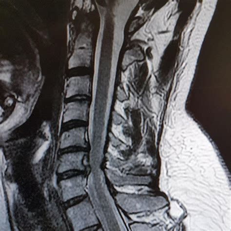 My c5 c6 nerve root compression : XRayPorn