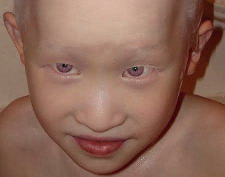 violet eyes of an albino child..beautiful What Is Vitiligo, Vitiligo ...