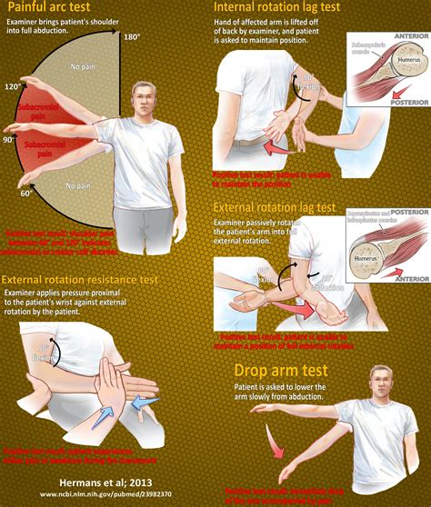 Impingement Syndrome – Back In Action