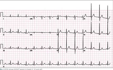 [PDF] ECG P wave abnormalities. | Semantic Scholar