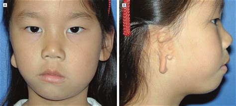 Isolated Microtia as a Marker for Unsuspected Hemifacial Microsomia ...