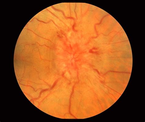 Optic Disc Edema and Hemorrhages with Subdural Hematoma - Retina Image Bank