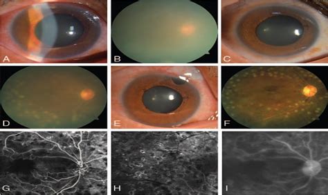 Management of neovascular glaucoma with intravitreal ranibiz... : Medicine