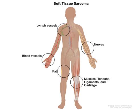 Soft Tissue Sarcoma Treatment - NCI