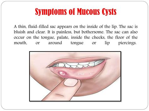 PPT - Mucous cysts (Mucoceles): Symptoms, causes, treatment and ...