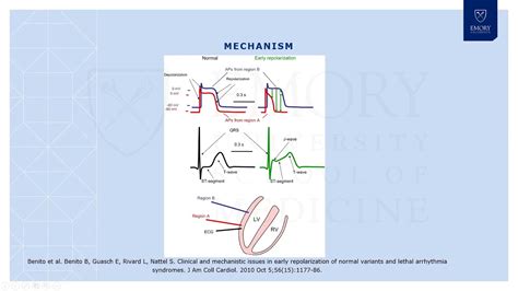 Early Repolarization Syndrome - YouTube