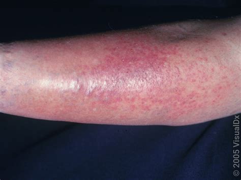 Venous Stasis Dermatitis: Images, Causes, and Treatment - GoodRx