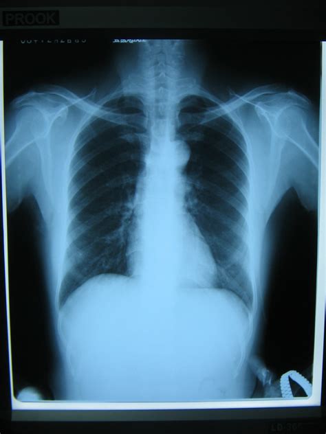 Medical X-ray Film/Medical Film/X-ray/Film/Radiology/Conventional ...