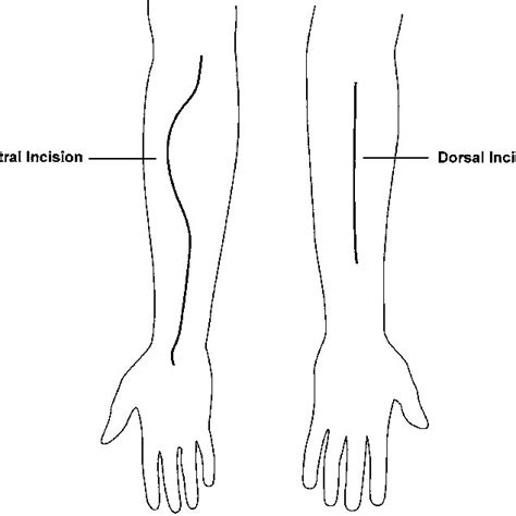 The position of the curvilinear ventral and dorsal incision in a ...