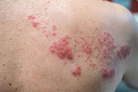 Shingles Treatment | Physicians Immediate Care