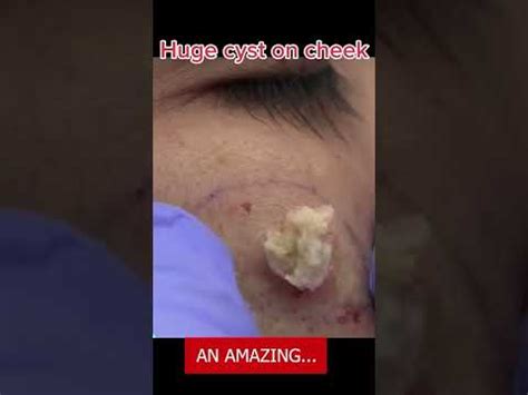 AN AMAZING...HUGE CYST ON CHEEK - YouTube