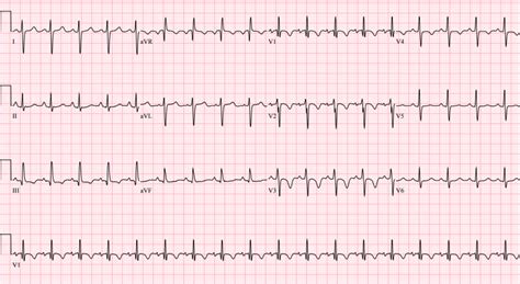 Abnormal Ecg Sinus Tachycardia | Images and Photos finder