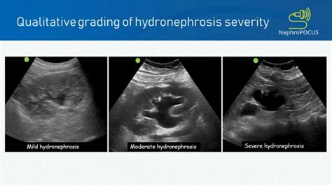 Hydronephrosis Grading Ultrasound