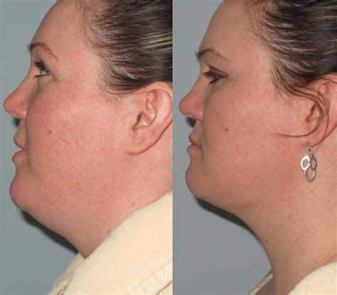 Double Chin Radio Frequency Liposuction | Double Chin Liposuction By LLV