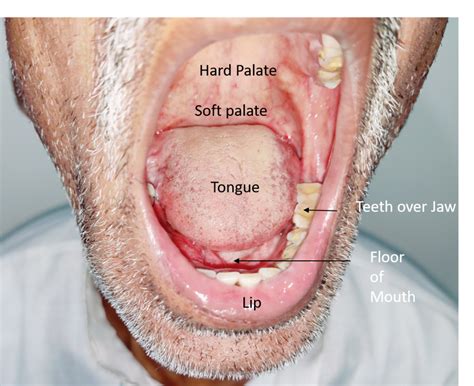 Pictures Of Early Signs Of Tongue Cancer - Infoupdate.org