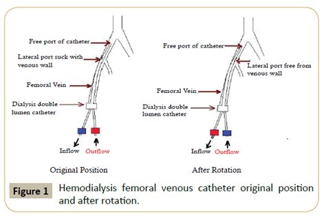 Femoral Venous Catheter