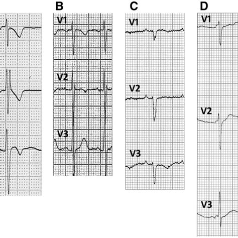 Repolarization abnormalities. Examples of ECG recordings showing ...