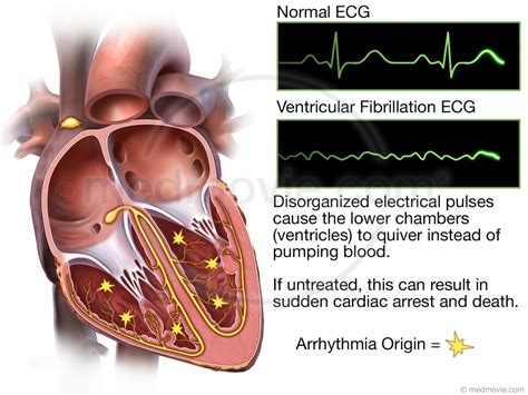 Ventricular Fibrillation – Medmovie.com