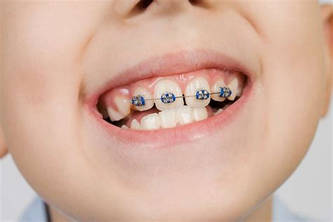 3 Benefits of Braces for Kids | Pediatric Orthodontics Houston Texas