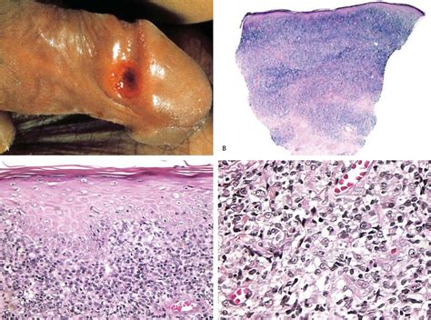 Primary syphilis-the chancre. A, a painless, eroded, button-like papule ...