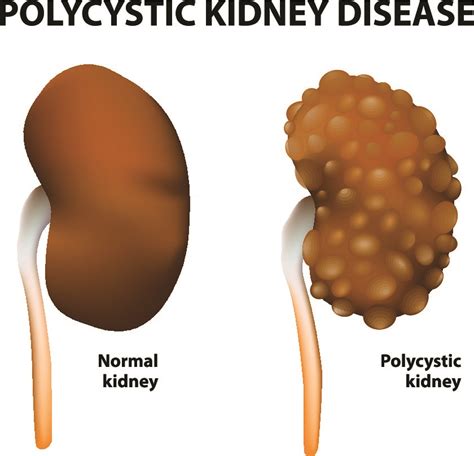 Cystic Kidney Disease: Types, Causes, Symptoms Treatment, 49% OFF