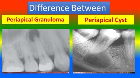 Periapical Granuloma Vs Periapical Cyst | The Best Porn Website