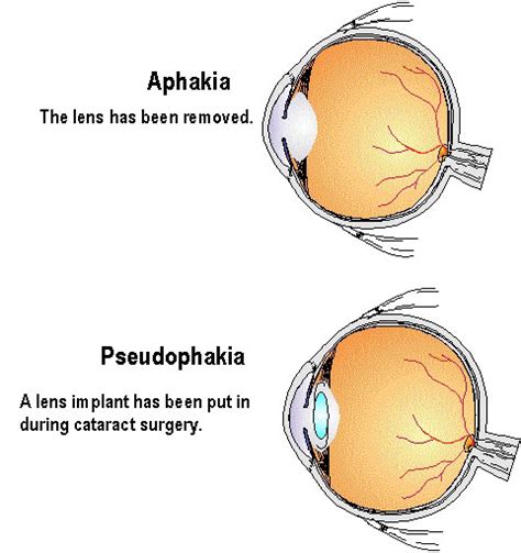 Z96.1 Presence of Intraocular Lens - Decision-Maker PLUS