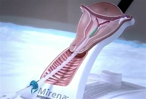 Compensation for Mirena IUD Victims Requiring Removal Surgery - Sign Up Now