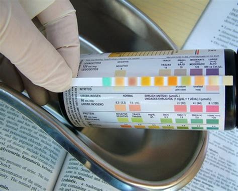 What Is Normal Amount of Protein in Urine? | Livestrong.com